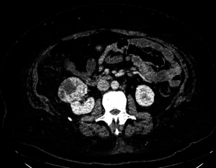 Axialer CT-Schnitt des Abdomens nach Kontrastmittelgabe auf Höhe der Nieren
