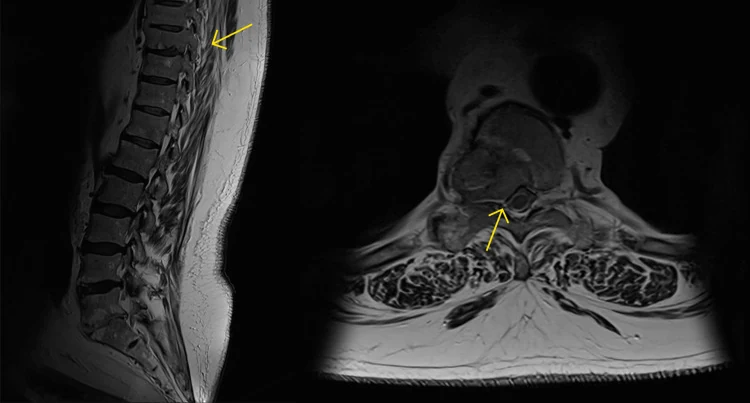 Zwei MRT-Bilder der Wirbelsäule: links sagittal mit gelbem Pfeil auf einen zerstörten Brustwirbelkörper, rechts axial mit gelbem Pfeil auf einen eingeengten Wirbelkanal