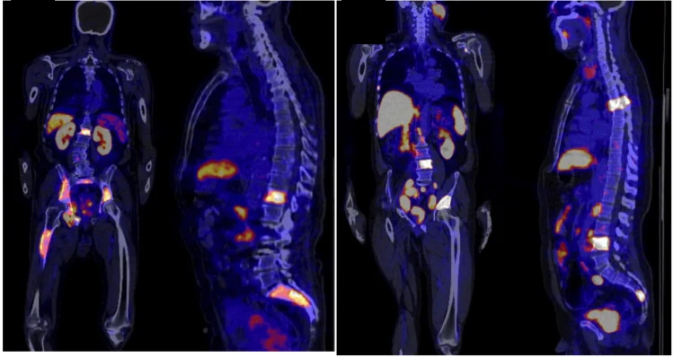 Zwei PET/CT-Ganzkörperpaare, jeweils frontal und seitlich: farbige Speicherherde in Becken, Oberschenkel und mehreren Wirbelkörpern, daneben physiologische Anreicherung in Nieren, Leber, Darm und Harnblase