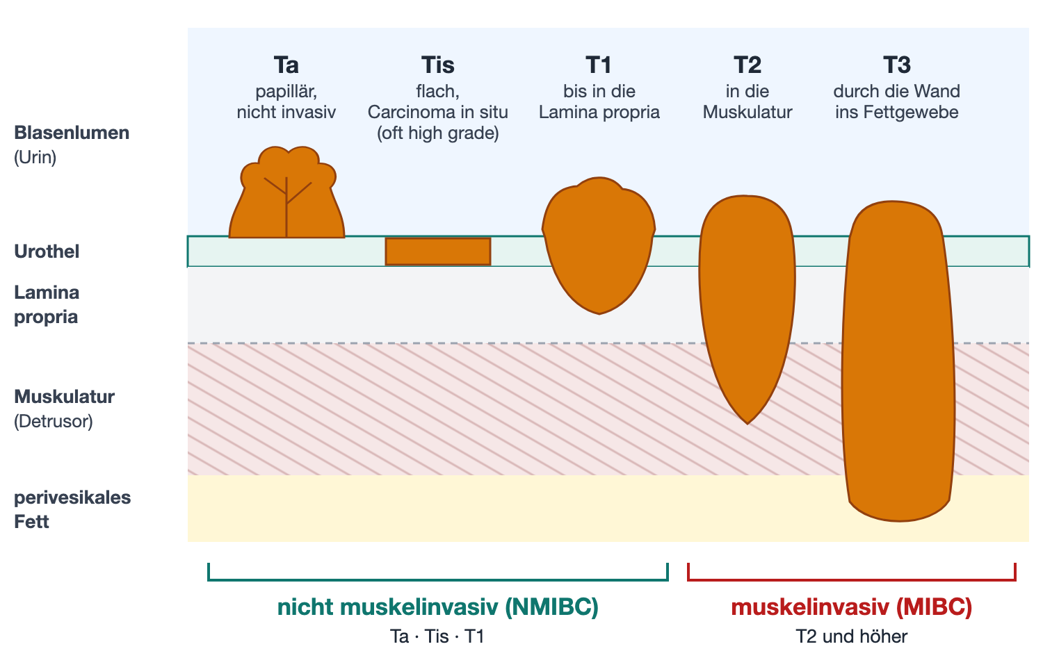 Schema der Blasenwand im Querschnitt mit Lumen oben und den Schichten Urothel, Lamina propria, Muskulatur und perivesikales Fett; fünf Tumoren zeigen von links nach rechts zunehmende Eindringtiefe: Ta papillär, Tis flach, T1 bis Lamina propria, T2 in die Muskulatur, T3 ins Fett; darunter Klammern für nicht muskelinvasiv und muskelinvasiv
