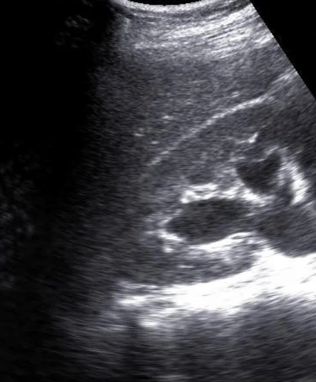 Sonografie der rechten Niere im Längsschnitt, darüber die Leber