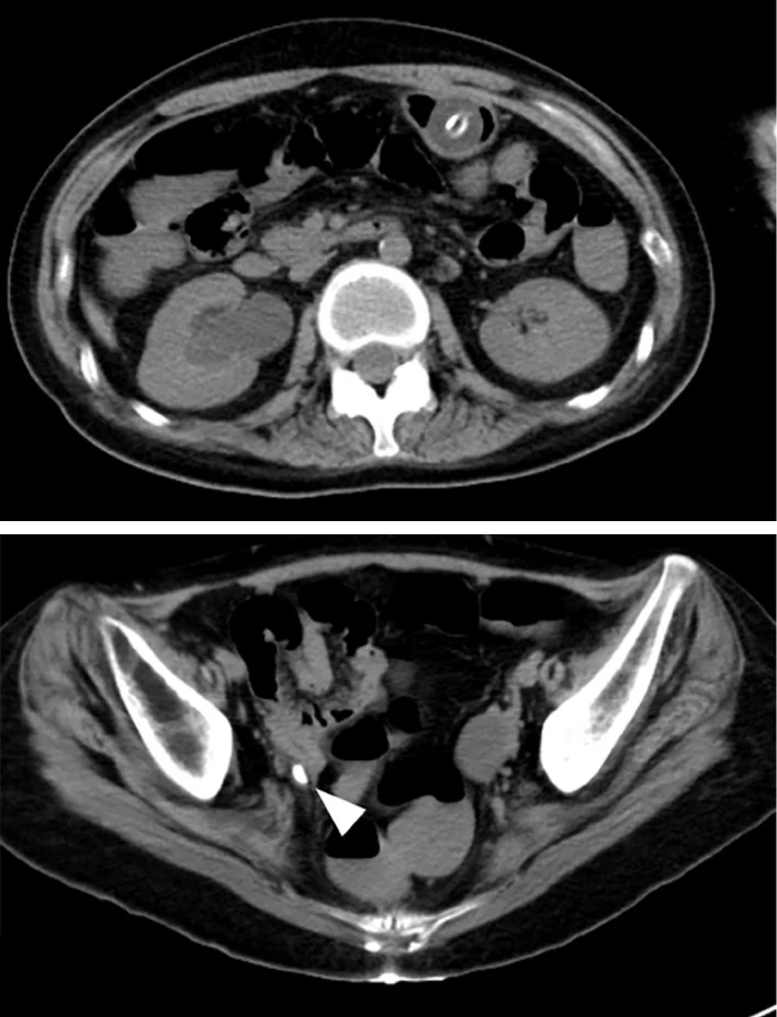 Natives CT des Abdomens, oben axial in Höhe der Nieren, unten axial im Becken mit einer weißen Pfeilspitze