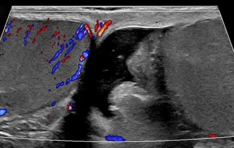 Farbdopplersonografie beider Hoden im gemeinsamen Querschnitt