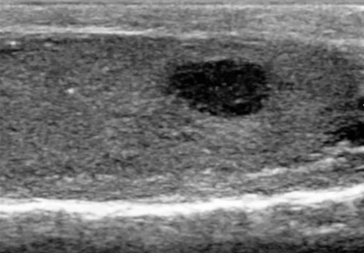 Graustufen-Sonografie eines Hodens im Längsschnitt
