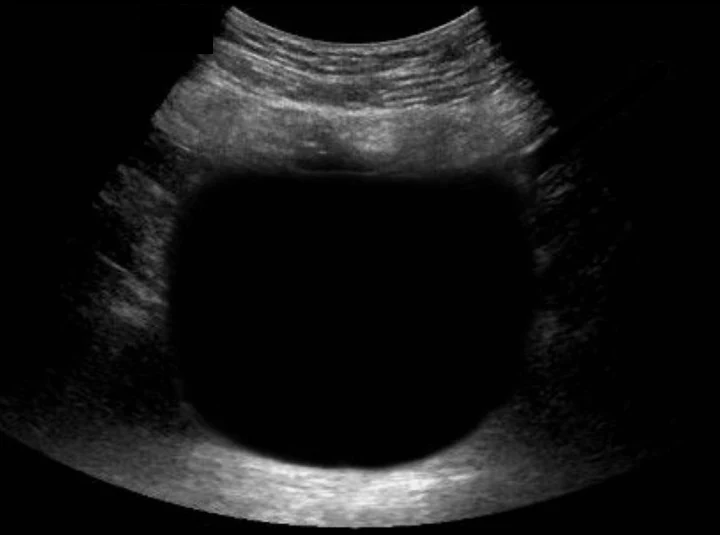 Transabdominale Sonografie des Unterbauchs im Querschnitt