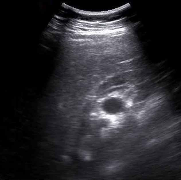 Sonografie einer rechten Niere im Längsschnitt unter der Leber mit einem rundlichen, echofreien Areal im Nierenzentrum