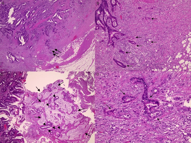 Mikroskopische Bilder in HE-Färbung in vier Feldern A bis D. Unregelmäßige, dunkel gefärbte Drüsenschläuche liegen in der Appendixwand und im angrenzenden Fettgewebe; schwarze Pfeile und Pfeilspitzen markieren einzelne Tumordrüsen. Im Feld C liegen einzelne Drüsen in hellen, schleimgefüllten Seen; Feld D zeigt Drüsen in starker Vergrößerung.