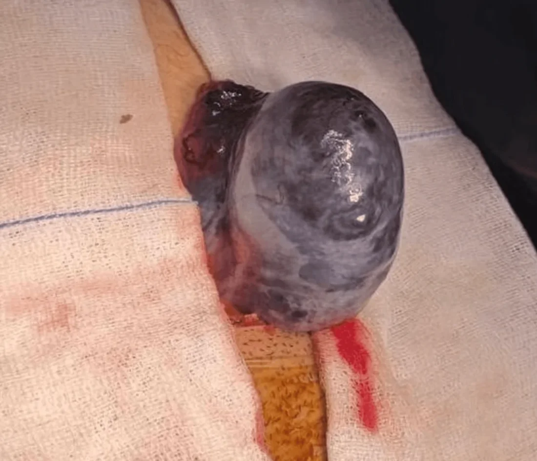 Intraoperatives Foto: Ein deutlich vergrößerter, glatter, prall gespannter Eierstock mit blau-schwarzer Verfärbung liegt auf Operationstüchern vor einem kleinen Unterbauchschnitt.