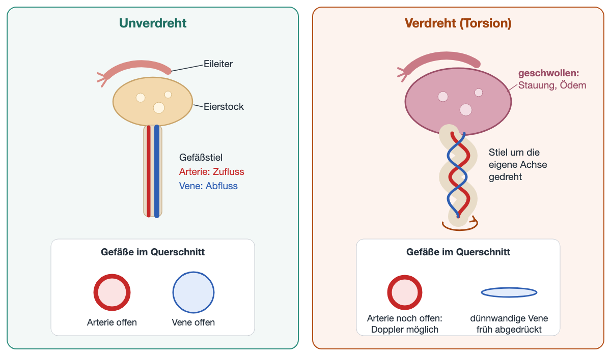 Zwei Felder. Links ein unverdrehter Eierstock mit Eileiter und geradem Gefäßstiel mit roter Arterie für den Zufluss und blauer Vene für den Abfluss; im Querschnitt darunter sind beide Gefäße offen. Rechts ist der Gefäßstiel mehrfach um die eigene Achse gedreht, der Eierstock ist vergrößert und livide verfärbt; im Querschnitt ist die dickwandige Arterie noch offen, die dünnwandige Vene dagegen flach zusammengedrückt.