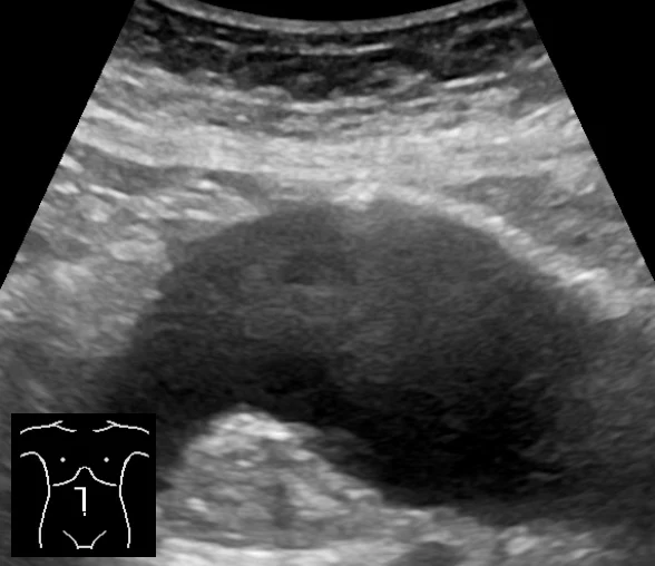 Ultraschall-Längsschnitt durch den Oberbauch. Unter der Bauchwand liegt ein großer, dunkler, sackförmig erweiterter Gefäßabschnitt: die aufgeweitete Bauchaorta. Unten links ein kleines Körpersymbol mit der Schallkopfposition in der Mittellinie.