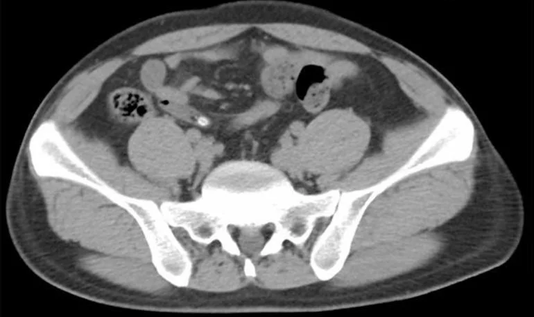 Axialer CT-Schnitt durch das Becken: Im rechten Unterbauch (im Bild links) liegt neben dem luftgefüllten Zäkum ein schlauchförmiger Darmabschnitt, der zur Mitte zieht; an seinem Ende ein kleiner, sehr heller, kalkdichter Fleck.