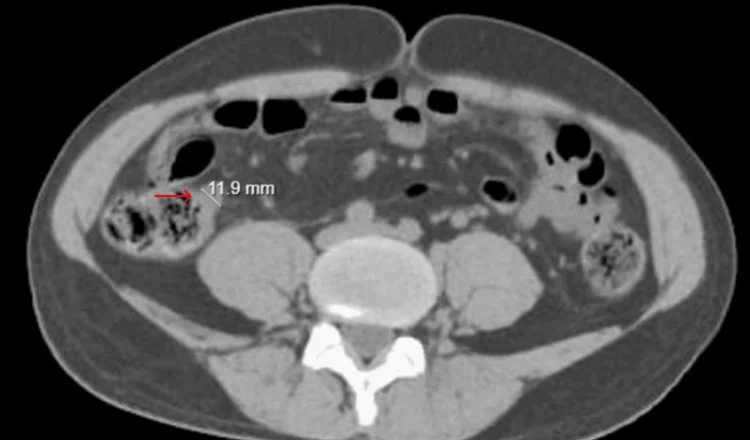 Axialer CT-Schnitt durch den Unterbauch mit Kontrastmittel: Im rechten Unterbauch (im Bild links) liegt neben dem stuhlgefüllten Zäkum ein rundlicher, verdickter Darmquerschnitt mit streifig verdichtetem Fett ringsum; ein roter Pfeil und eine Messlinie mit „11.9 mm“ markieren ihn.