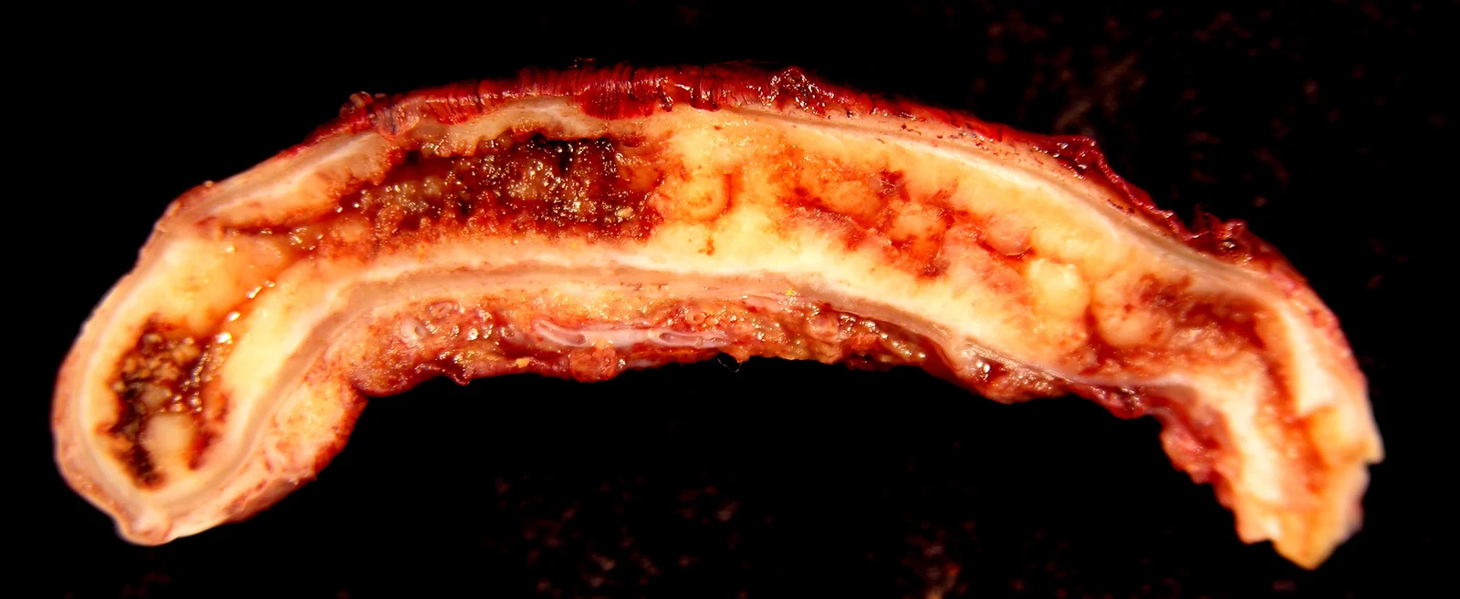 Längs aufgeschnittene, operativ entfernte Appendix auf schwarzem Untergrund. Das Organ ist verdickt und wurstförmig. Die Schleimhaut im Inneren ist dunkelrot und unregelmäßig, die Wand darum gelblich-weiß und geschwollen. Ein Wanddefekt oder eine Eiterhöhle ist nicht zu sehen.