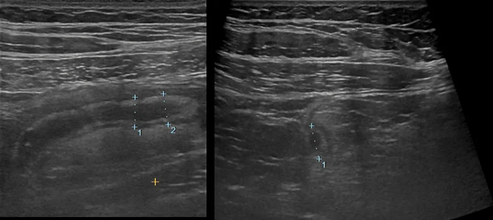 Zwei Ultraschallbilder des rechten Unterbauchs nebeneinander: links ein Längsschnitt, rechts ein Querschnitt. In der Tiefe liegt jeweils eine verbreiterte, tubuläre, echoarme Struktur mit echoreicher Wandbegrenzung; kleine Messkreuze markieren ihren Außendurchmesser. Darüber die geschichteten Bauchwandschichten.