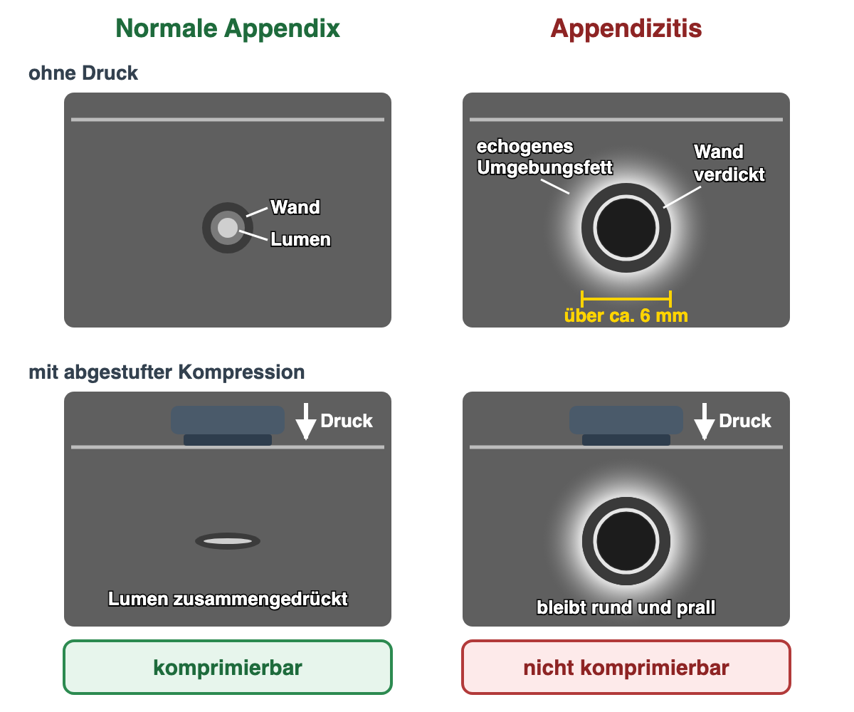 Vier schematische Ultraschall-Querschnitte: Die normale Appendix ist klein und wird unter Druck des Schallkopfs flach zusammengedrückt; die entzündete Appendix ist größer als etwa 6 mm, hat eine verdickte Wand, ein dunkles Lumen und helles Umgebungsfett und bleibt unter Druck rund.