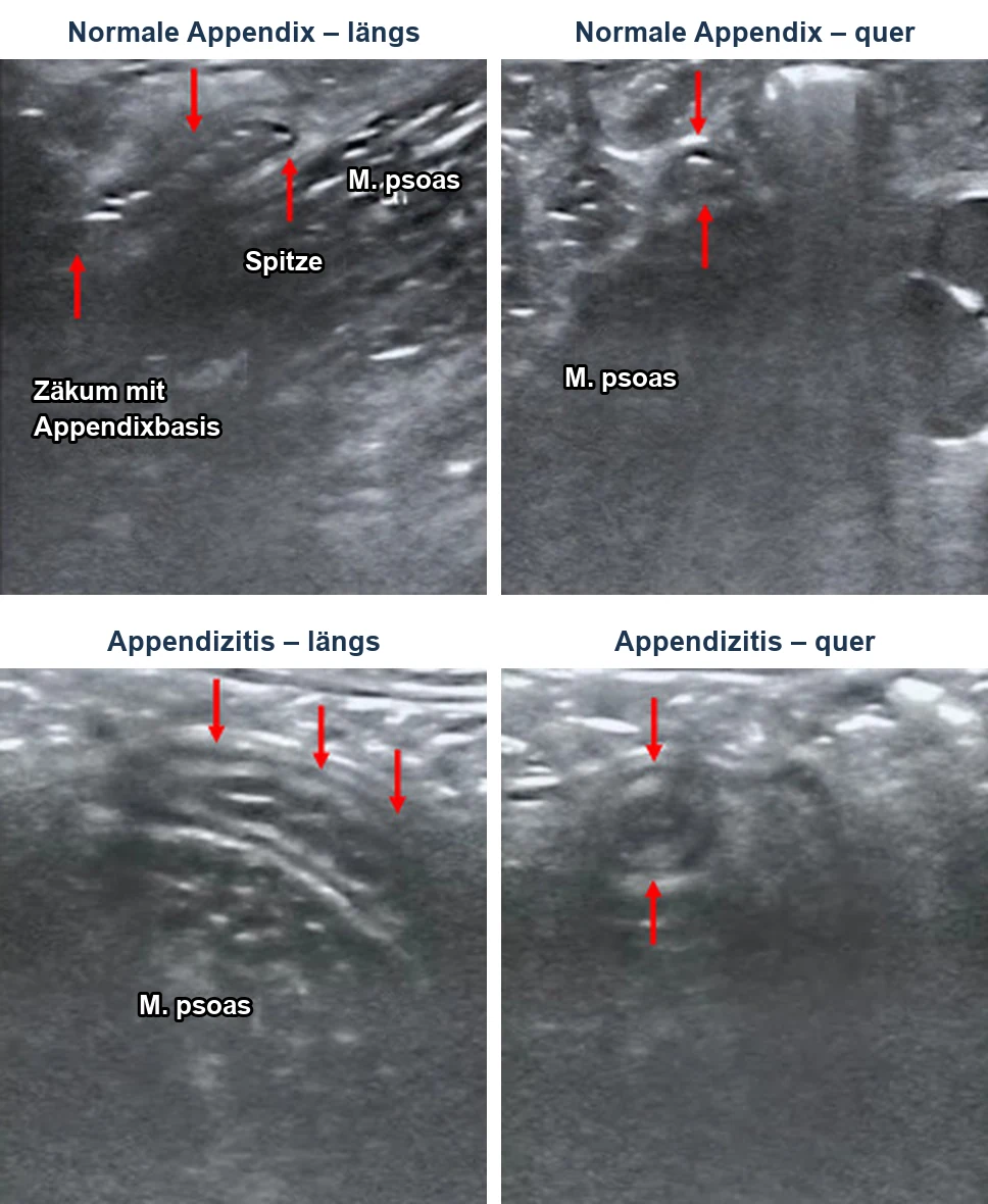 Vier reale Ultraschallbilder im Vergleich: oben die normale Appendix längs vom Zäkum bis zur Spitze und quer als kleine Struktur vor dem M. psoas; unten eine Appendizitis längs als verdickte tubuläre Struktur und quer als runde Struktur mit Wand und Lumen. Rote Pfeile markieren jeweils die Appendix.