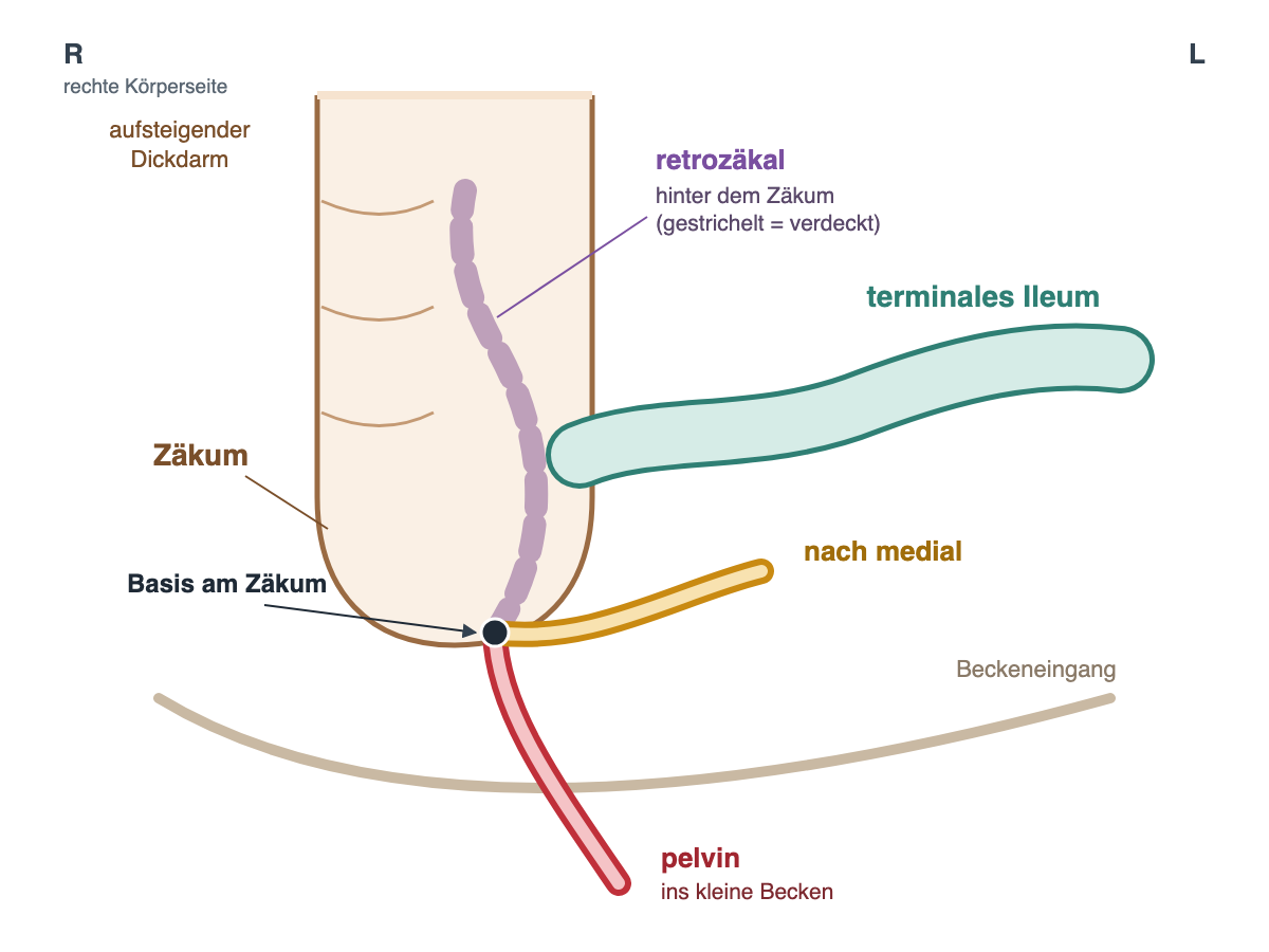 Vorderansicht von aufsteigendem Dickdarm, Zäkum und einmündendem terminalem Ileum. Ein dunkler Punkt markiert die Appendixbasis am unteren Zäkum. Von dort gehen drei mögliche Verläufe aus: gelb nach medial unterhalb des Ileums, violett gestrichelt hinter dem Zäkum nach oben (retrozäkal) und rot nach unten über den Beckeneingang ins kleine Becken (pelvin). Die rechte Körperseite liegt links im Bild.