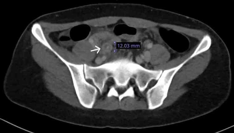 Axialer CT-Schnitt mit markiertem verdicktem Appendixquerschnitt rechts bei der Patientin, links im Bild; die vorhandene Messung lautet 12.03 mm.
