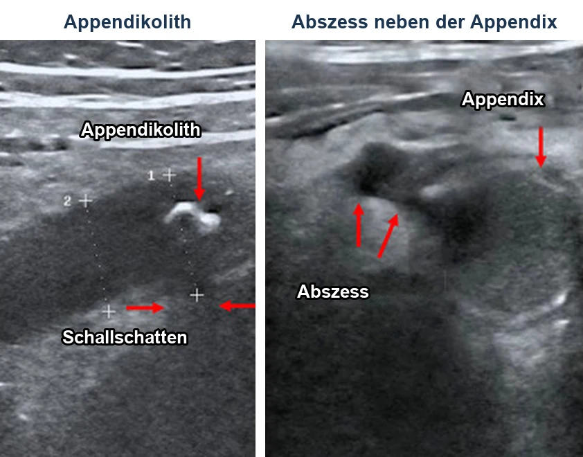 Zwei reale Ultraschallbilder: links ein heller Appendikolith mit dunklem Schallschatten dahinter in einer erweiterten Appendix, rechts eine echoarme Flüssigkeitsansammlung neben einer quer getroffenen Appendix.