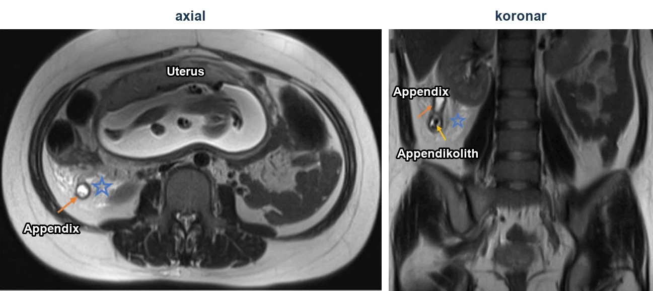 Reale MRT-Aufnahmen einer Schwangeren in der 20. Woche: links axial mit Uterus und Fetus, rechts unten im Bild eine erweiterte, flüssigkeitsgefüllte Appendix; rechts koronar die Appendix mit Appendikolith. Pfeile und Stern markieren die Befunde.