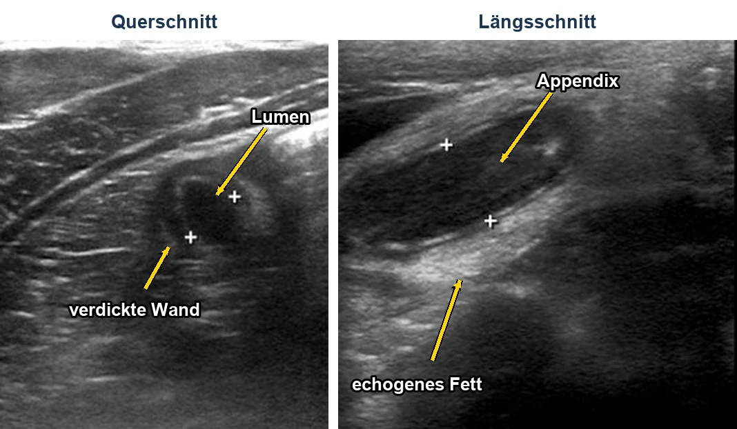 Reale Ultraschallbilder einer Appendizitis: links im Querschnitt eine runde Struktur mit verdickter Wand und dunklem Lumen, rechts im Längsschnitt eine erweiterte, schlauchförmige Appendix mit hell erscheinendem Fettgewebe darunter.