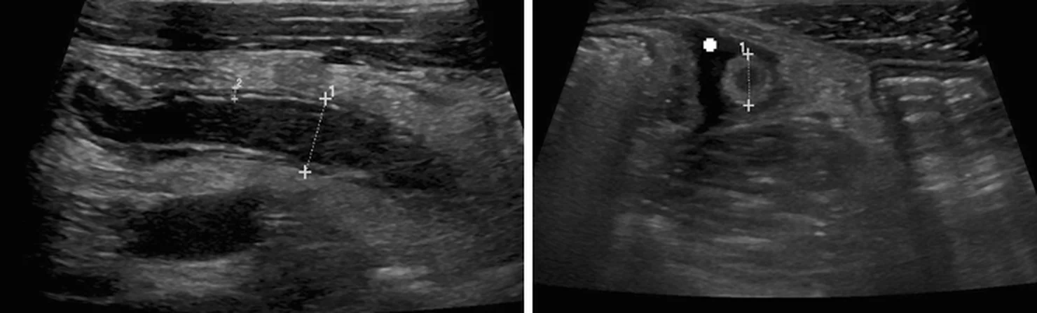 Reales Appendizitis-Sonogramm, links längs und rechts quer, mit sichtbarer Wandschichtung und dunklerem Lumen.