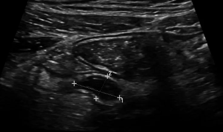Anderer realer Sonografiefall: längliche, flüssigkeitsgefüllte Appendix mit dunklem Inneren, erkennbarer Wand und weißen Messkreuzen.