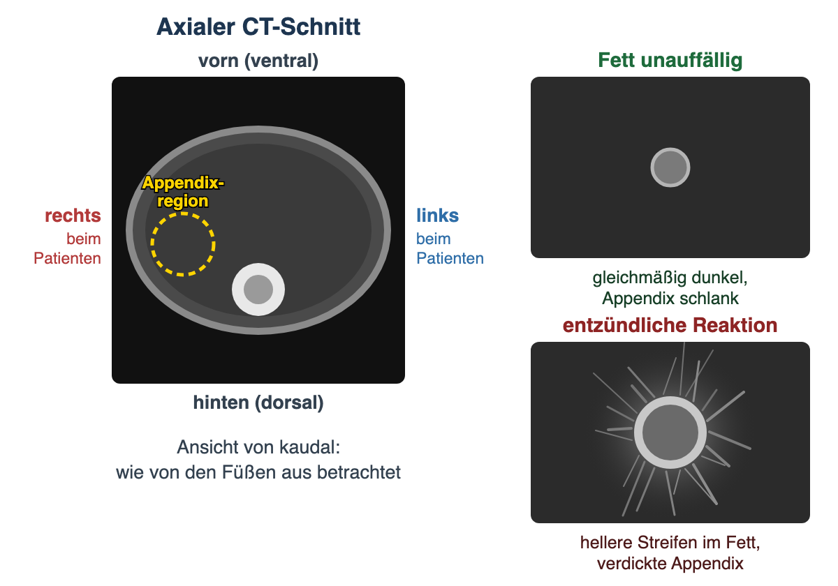Schema eines axialen CT-Schnitts: oben vorn, unten hinten, die rechte Patientenseite liegt links im Bild, dort ist die Appendixregion markiert. Daneben zwei Ausschnitte: unauffälliges, gleichmäßig dunkles Fett um eine schlanke Appendix und entzündliche Reaktion mit helleren Streifen im Fett um eine verdickte Appendix.
