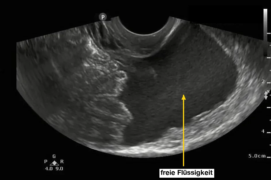 Transvaginales Ultraschallbild: Im Becken liegt eine große, dunkle, echoarme Fläche mit feinen Binnenechos, markiert als freie Flüssigkeit; links daneben heller strukturiertes Gewebe.