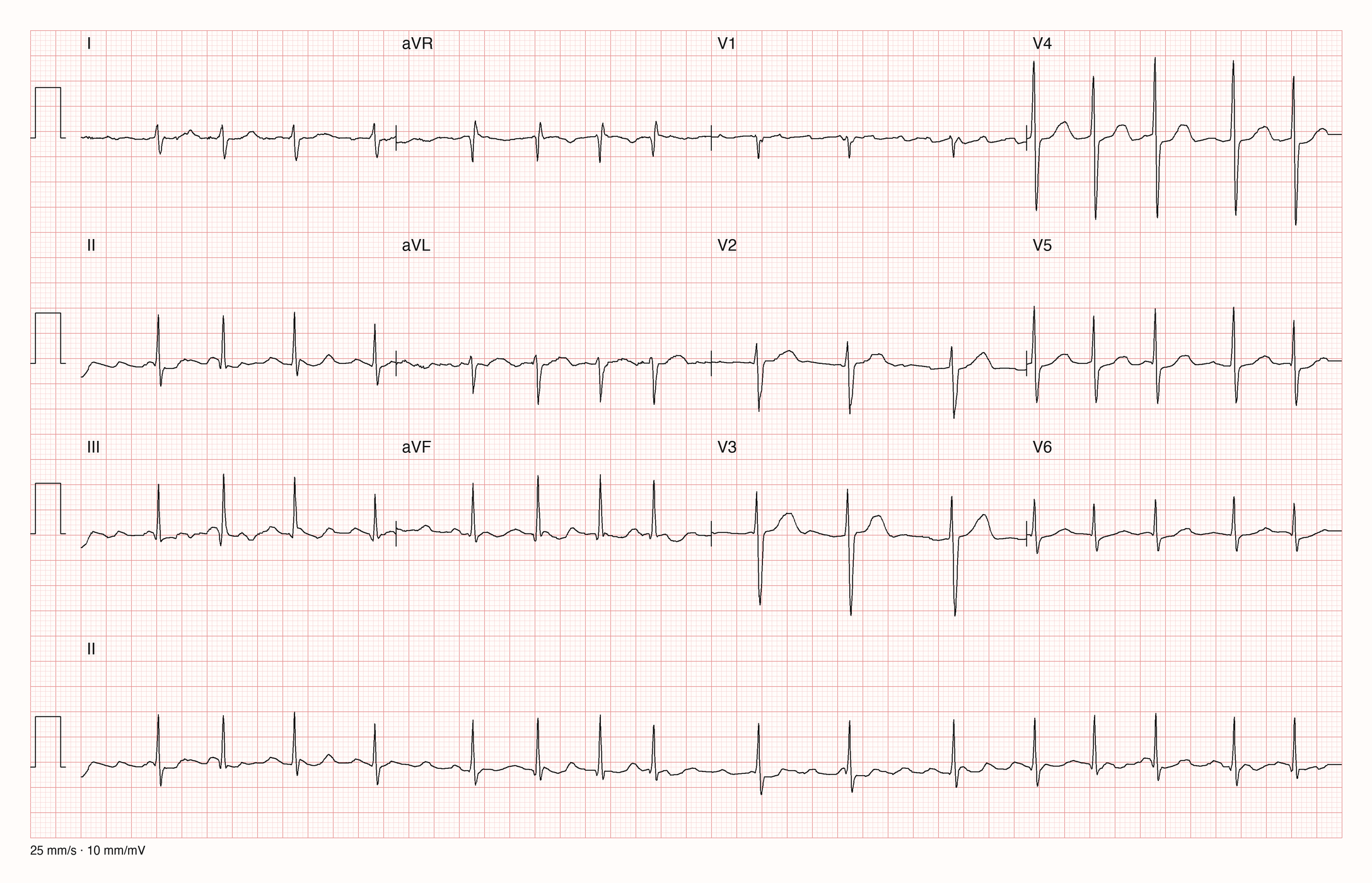 Echtes 12-Kanal-EKG in 3×4-Anordnung mit Rhythmusstreifen II, 25 mm/s, 10 mm/mV: schmale Kammerkomplexe in wechselnden, unregelmäßigen Abständen; vor den Kammerkomplexen keine gleichförmigen P-Wellen, die Grundlinie zwischen den Schlägen ist leicht unruhig.