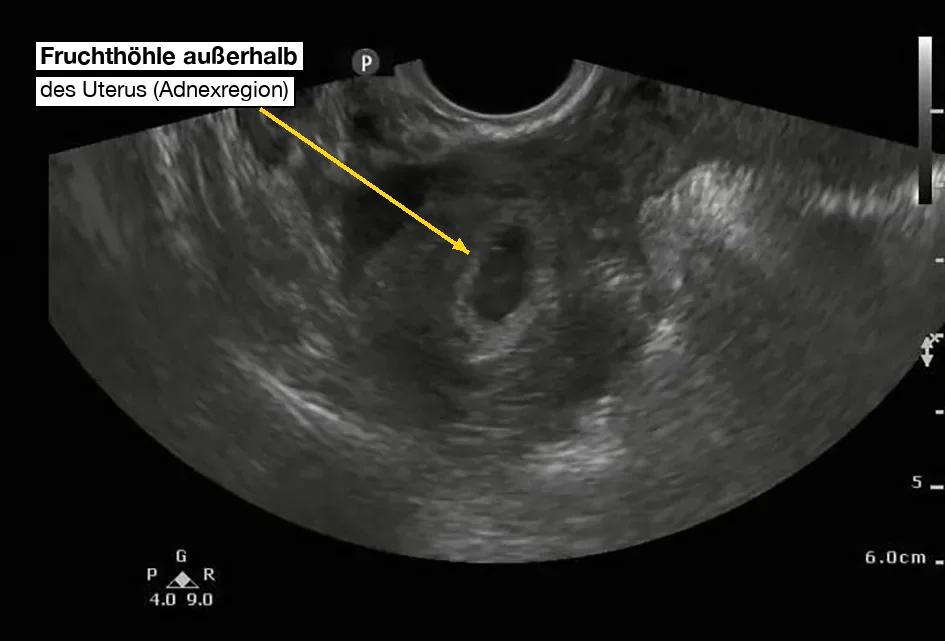 Transvaginales Ultraschallbild der rechten Adnexregion: In echoarmem Gewebe liegt eine kleine ovale, dunkle Fruchthöhle mit hellem Randsaum; ein Pfeil markiert sie als Fruchthöhle außerhalb des Uterus.