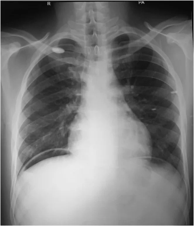 Frontale Röntgenaufnahme des Thorax eines jungen Mannes. Unter beiden Zwerchfellkuppeln liegt eine schmale, dunkle Luftsichel zwischen Zwerchfell und den darunterliegenden Oberbauchorganen.