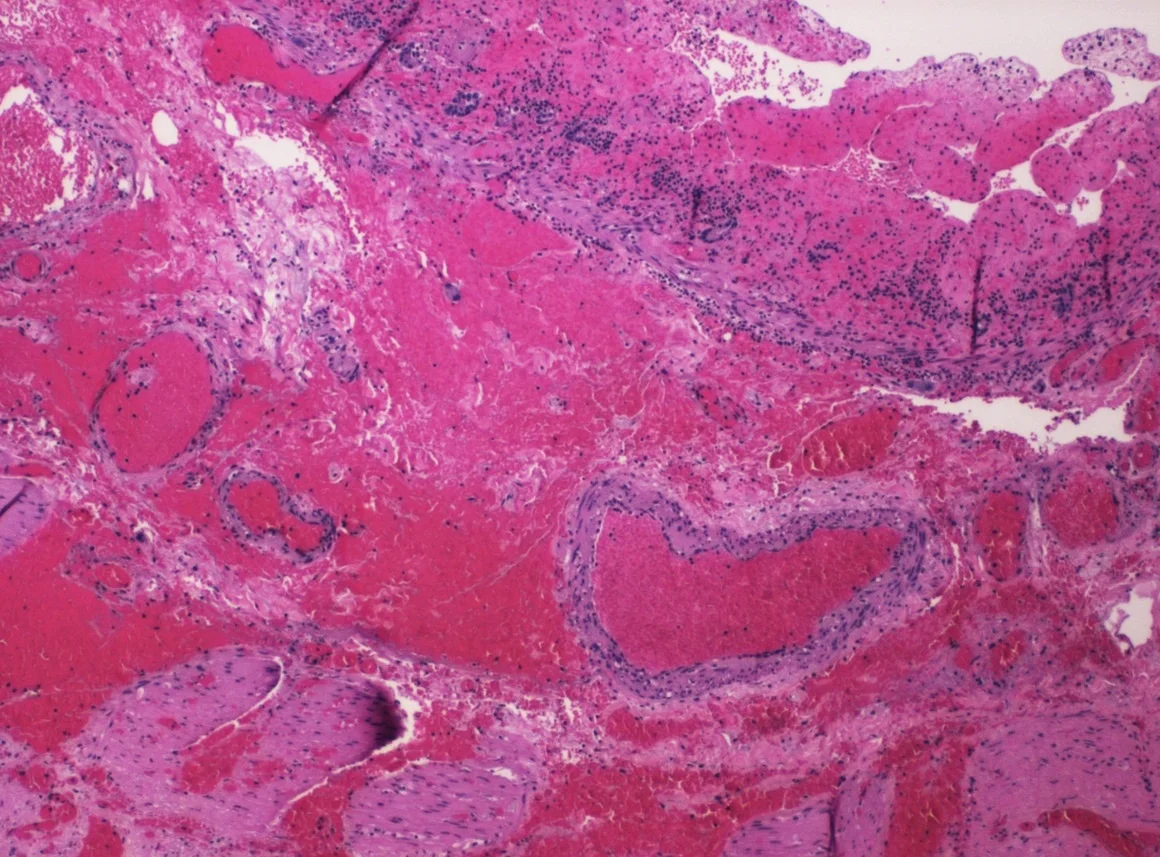 Mikroskopisches Bild der Dünndarmwand in HE-Färbung. Das Gewebe ist großflächig von roten Blutungen durchsetzt; mehrere Gefäße sind weit und prall mit Blut gefüllt.