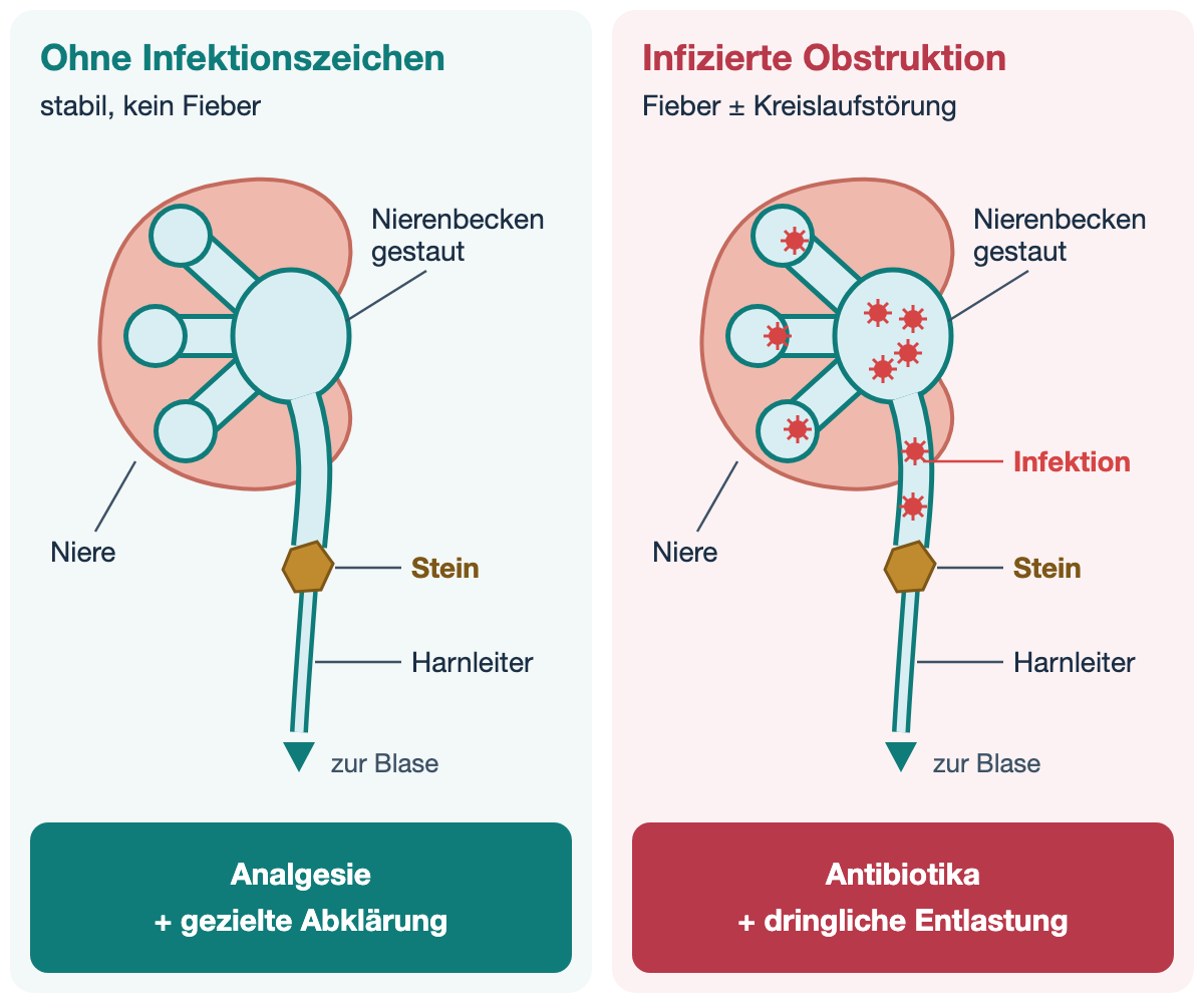 Zwei Felder nebeneinander mit je einer gezeichneten Niere, gestautem Nierenbecken mit erweiterten Kelchen und einem Harnleiter, in dem unterhalb des Staus ein Stein liegt; unter dem Stein ist der Harnleiter schmal, ein Pfeil zeigt zur Blase. Links: ohne Infektionszeichen, stabil, kein Fieber; darunter Analgesie und gezielte Abklärung. Rechts: infizierte Obstruktion mit Fieber und möglicher Kreislaufstörung; rote Erregersymbole liegen im Nierenbecken, in den Kelchen und im Harnleiter oberhalb des Steins; darunter Antibiotika und dringliche Entlastung.