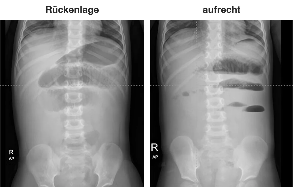 Zwei Röntgenaufnahmen desselben Kindes nebeneinander, links in Rückenlage, rechts aufrecht. In Rückenlage sind erweiterte, gasgefüllte Darmschlingen ohne waagerechte Grenzflächen zu sehen. In der aufrechten Aufnahme bilden mehrere Schlingen scharfe waagerechte Luft-Flüssigkeitsspiegel.