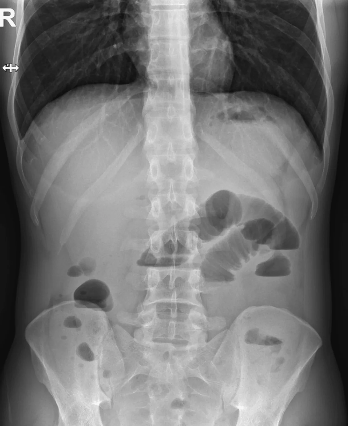 Aufrechte Röntgenaufnahme von Abdomen und unterem Thorax eines Erwachsenen. Im Mittel- und Unterbauch liegen mehrere erweiterte, gasgefüllte Dünndarmschlingen. Rechts und links im Bild bilden sich waagerechte Grenzflächen: oben dunkle Luft, unten hellerer Inhalt. Oben links steht die Seitenmarkierung R.