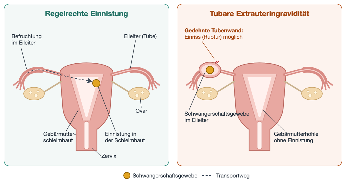 Zwei schematische Vorderansichten von Gebärmutter, Eileitern und Eierstöcken. Links: Weg der befruchteten Eizelle vom Eileiter in die Gebärmutterhöhle, ein goldener Punkt markiert die Einnistung in der Gebärmutterschleimhaut. Rechts: Der goldene Punkt liegt in einem aufgetriebenen Eileiter, dessen gedehnte Wand einreißen kann; die Gebärmutterhöhle bleibt leer.