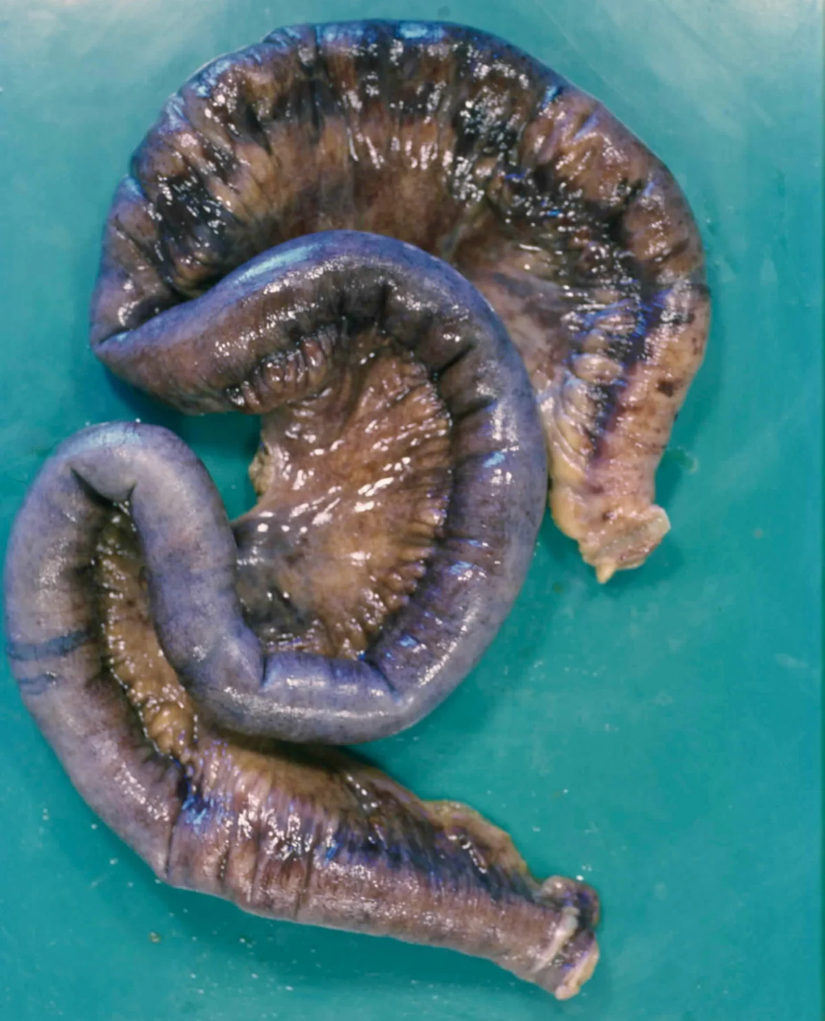 Operativ entfernter Ileumabschnitt auf grünem Untergrund. Die Darmwand ist über weite Strecken dunkelviolett bis blauschwarz verfärbt, die Schleimhaut wirkt gestaut und eingeblutet.