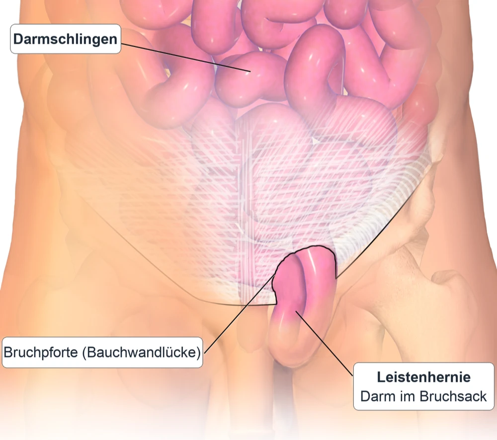 Medizinische Illustration des Unterbauchs von vorn: Darmschlingen in der Bauchhöhle; in der Leiste tritt eine Darmschlinge durch eine Lücke der Bauchwand, die Bruchpforte, in einen Bruchsack aus.