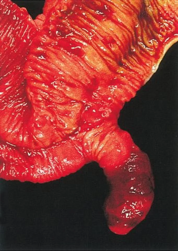 Foto eines eröffneten, kräftig roten Dünndarmabschnitts mit querer Schleimhautfaltung vor schwarzem Hintergrund. Aus der Darmwand ragt unten rechts eine fingerförmige, blind endende Ausstülpung.