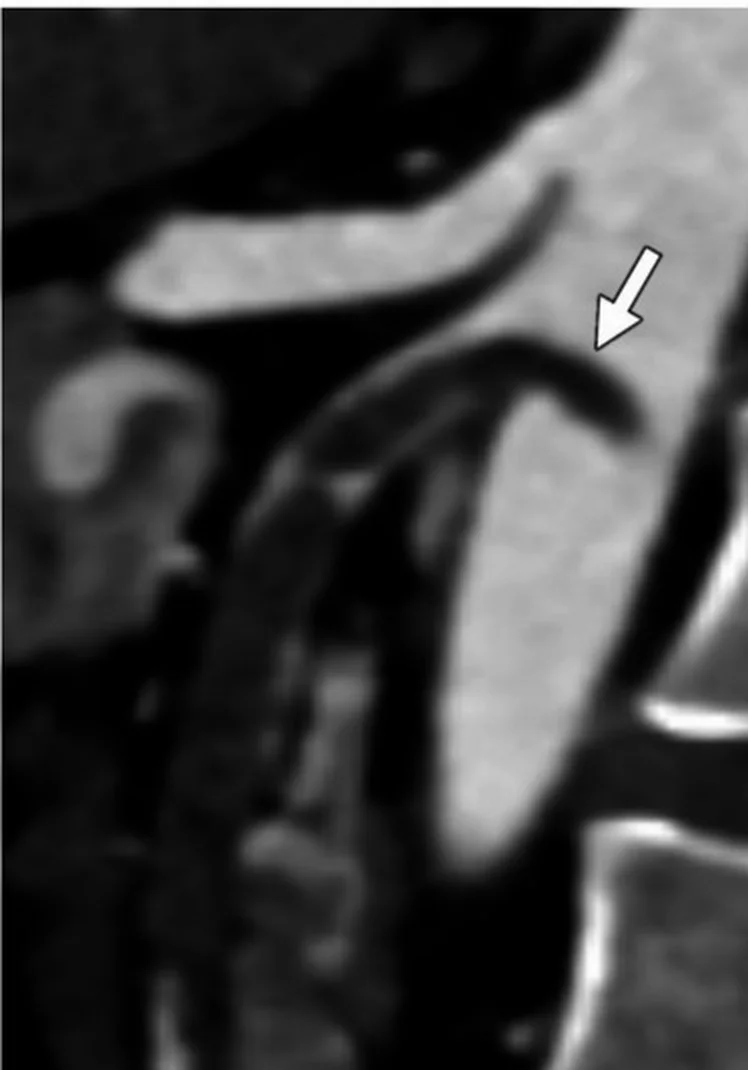 Sagittale CT-Angiografie im Ausschnitt, Kopf oben, Wirbelsäule rechts unten im Bild. Die Aorta ist als breites, hell kontrastiertes Gefäß zu sehen. Ein Pfeil zeigt auf den Abgang der A. mesenterica superior: Dieses Gefäß bleibt auf seiner ganzen sichtbaren Länge dunkel, und ein dunkler Embolus ragt bis in die helle Aorta hinein.