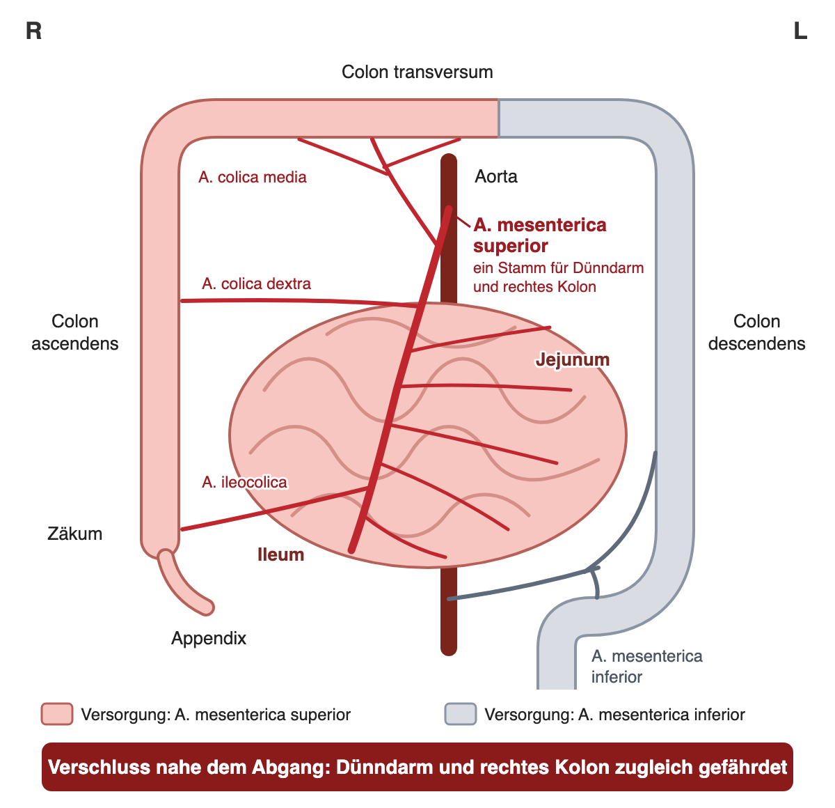 Schematische Vorderansicht des Bauchs, rechte Körperseite links im Bild. Aus der Aorta geht die A. mesenterica superior ab; ihre Äste A. colica media, A. colica dextra, A. ileocolica sowie die Dünndarmarterien ziehen zum rosa markierten Versorgungsgebiet aus Jejunum, Ileum, Zäkum mit Appendix, Colon ascendens und den proximalen zwei Dritteln des Colon transversum. Grau markiert sind das distale Drittel des Colon transversum und das Colon descendens, das am unteren Bildrand weiter nach distal zieht; sie werden von der A. mesenterica inferior versorgt. Unten ein roter Kasten: Verschluss nahe dem Abgang gefährdet Dünndarm und rechtes Kolon zugleich.