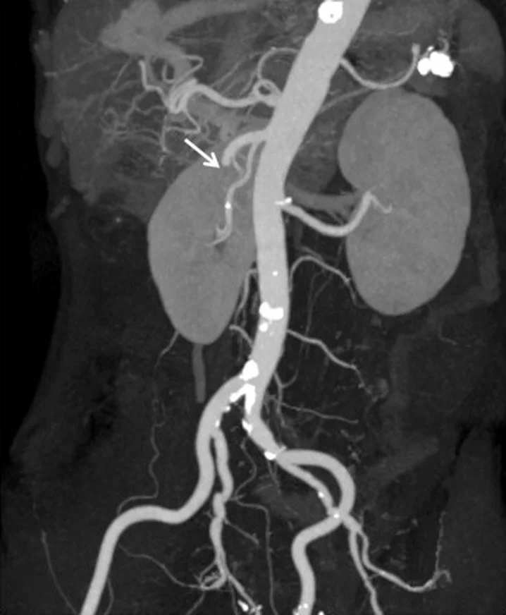 Koronale CT-Angiografie als Maximumintensitätsprojektion mit Aorta, Nieren und Beckenarterien; ein Pfeil zeigt auf den Abgang der A. mesenterica superior, die dort abbricht.