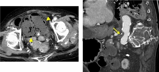 Zwei CT-Schnittbilder mit Kontrastmittel. Links ein Querschnitt durch das Becken: Eine Darmschlinge enthält in ihrer Wand viele kleine schwarze Gasbläschen; zwei gelbe Pfeilspitzen markieren sie. Rechts ein seitlicher Längsschnitt: Die kontrastierte Aorta ist hell; ein gelber Pfeil zeigt auf die abgehende obere Mesenterialarterie, in der ein Embolus den Kontrastmittelfluss unterbricht.
