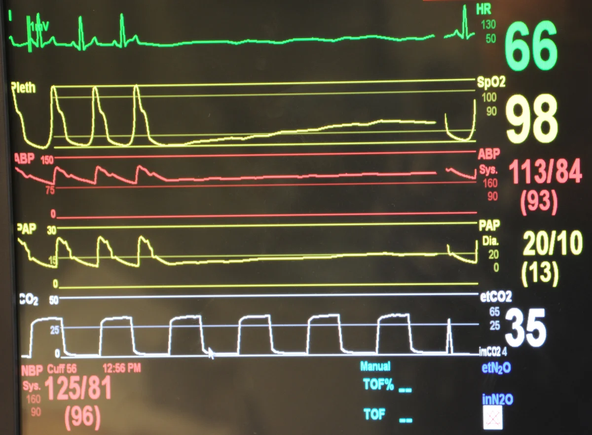 Foto eines Überwachungsmonitors mit Kurven und Zahlenwerten: grüne EKG-Kurve mit Herzfrequenz 66, gelbe Pulsoxymetriekurve mit Sauerstoffsättigung 98, rote arterielle Druckkurve mit 113/84 mmHg, eine Kapnografiekurve mit endexspiratorischem CO2 von 35 und unten eine nichtinvasive Blutdruckmessung von 125/81 mmHg.