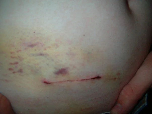 Foto einer frischen, kurzen queren Operationsnarbe im rechten Unterbauch mit umgebenden Blutergüssen, zwei Tage nach Appendektomie.