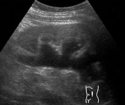 Ultraschall-Längsschnitt einer Niere: Im Zentrum liegt ein breites, verzweigtes, echoarmes (dunkles) Hohlraumsystem, das sich in mehrere Kelche fortsetzt; unten rechts ein Körperpiktogramm zur Schallkopfposition.