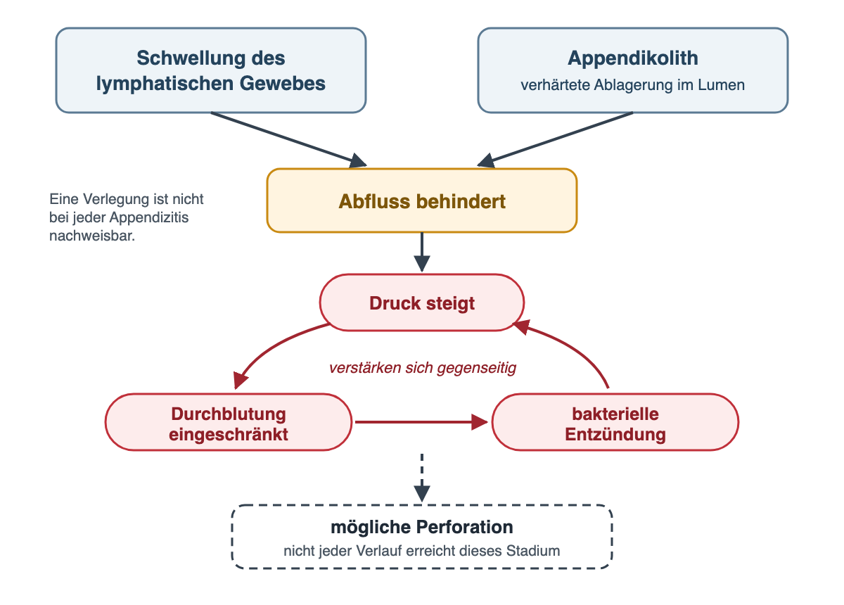 Flussdiagramm: Schwellung des lymphatischen Gewebes und Appendikolith, eine verhärtete Ablagerung im Lumen, führen beide zu behindertem Abfluss. Daraus folgt steigender Druck. Druck, eingeschränkte Durchblutung und bakterielle Entzündung sind als Kreis verbunden und verstärken sich gegenseitig. Ein gestrichelter Pfeil führt zur möglichen Perforation mit dem Hinweis, dass nicht jeder Verlauf dieses Stadium erreicht. Seitlich steht: Eine Verlegung ist nicht bei jeder Appendizitis nachweisbar.
