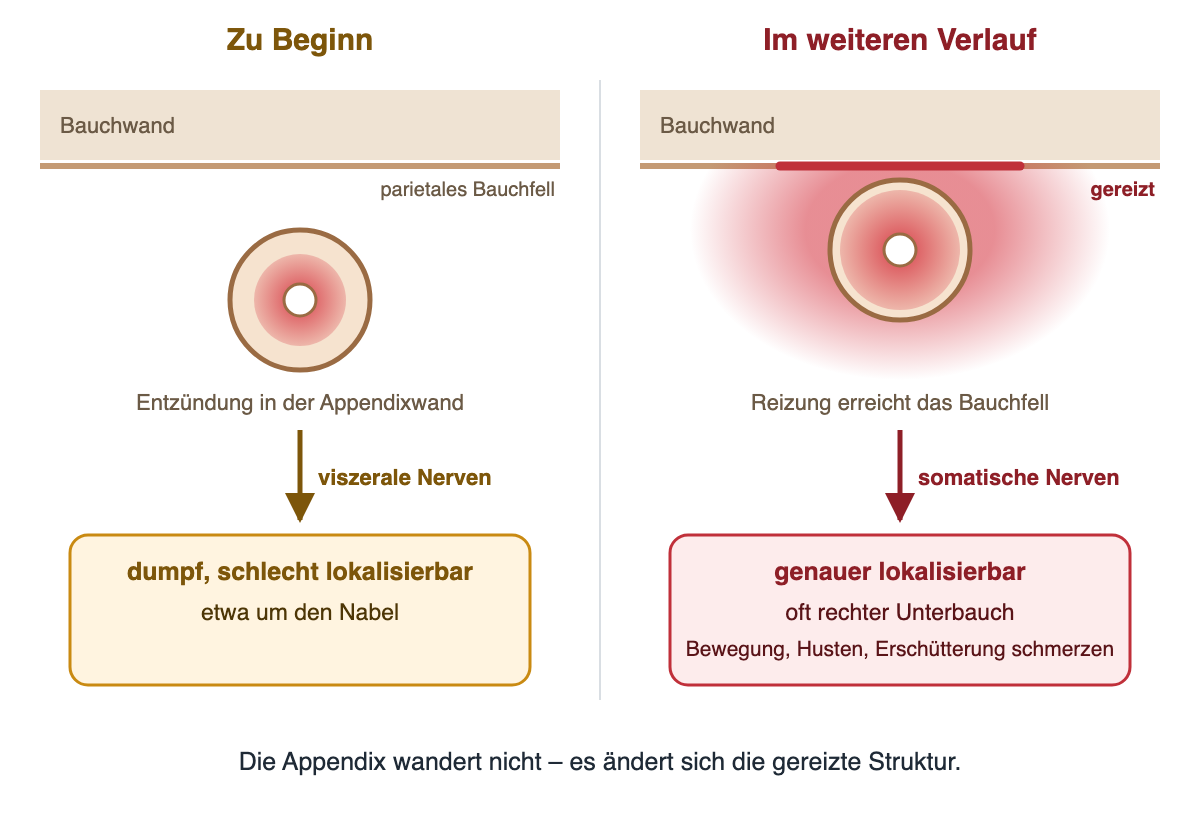 Zwei Bildhälften mit Bauchwand, parietalem Bauchfell und einer quer geschnittenen Appendix darunter. Links, zu Beginn: Die Entzündung liegt nur in der Appendixwand; über viszerale Nerven entsteht dumpfer, schlecht lokalisierbarer Schmerz etwa um den Nabel. Rechts, im weiteren Verlauf: Die Entzündung reicht bis an das parietale Bauchfell, das rot als gereizt markiert ist; über somatische Nerven wird der Schmerz genauer lokalisierbar, oft im rechten Unterbauch, und Bewegung, Husten und Erschütterung schmerzen. Unten: Die Appendix wandert nicht – es ändert sich die gereizte Struktur.