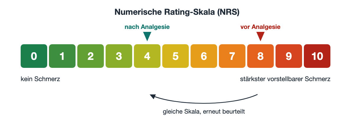 Numerische Rating-Skala mit elf farbigen Feldern von 0, kein Schmerz, bis 10, stärkster vorstellbarer Schmerz; eine Markierung bei 8 vor Analgesie und eine bei 4 nach Analgesie.